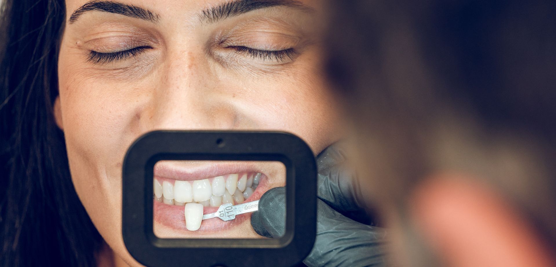 Pola Teeth Whitening in West Moors: £350 (Save £100)