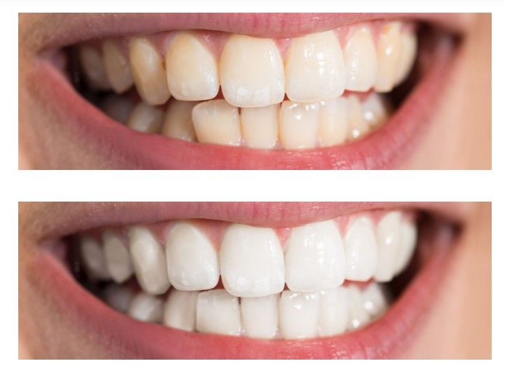 Whitening